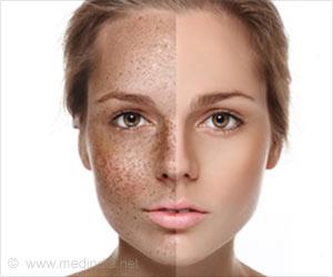 pigmentation removal, Best pigmentation treatment in Udaipur